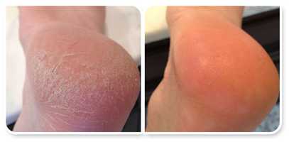 Smootherning and treating cracked heels