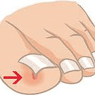 Ingrown toenail image