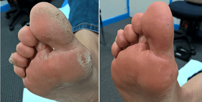 Callus and dry skin treatment example