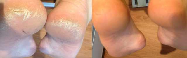 Cracked and dry heels treatment