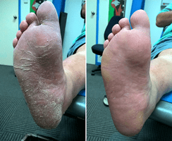 Before and after treatment of severed dry skin